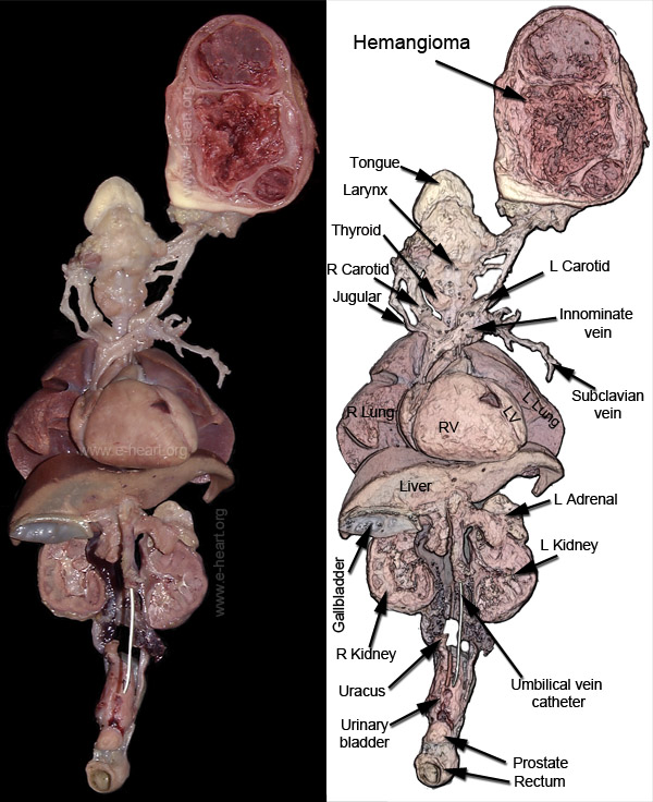 Congenital hemangioma head gross